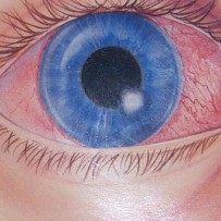 Loss of Sight…