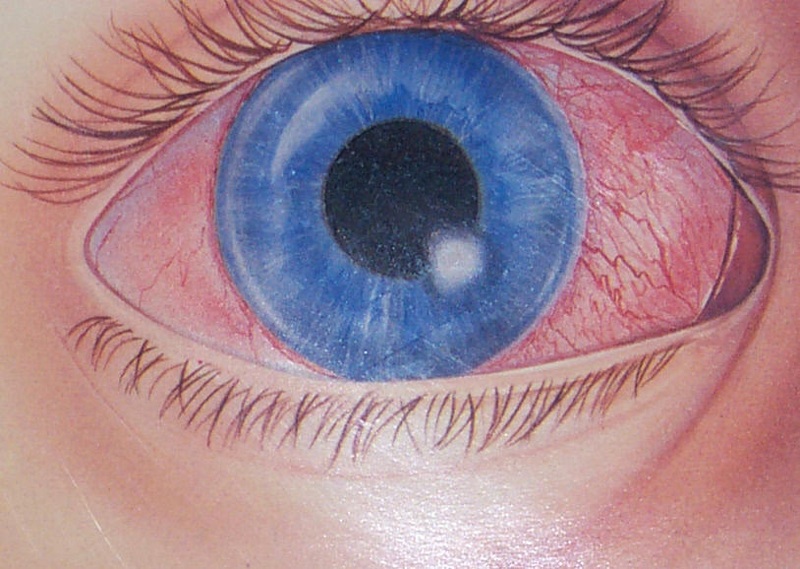 Loss of Sight…